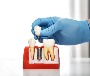 All-on-X dental implants in Clapton being placed by a dentist at Ardent Smile Clinic